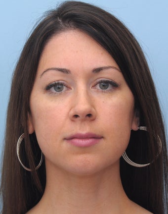 Non-Surgical Chin Augmentation Using Perlane