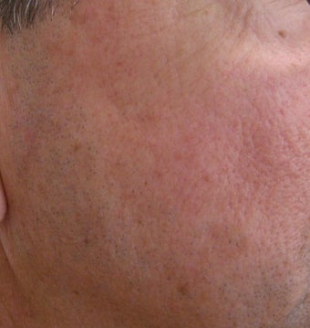 58 year old Male with undesired Pigmentation on face