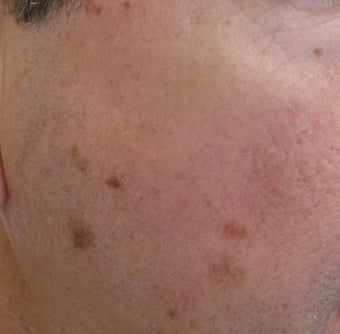 58 year old Male with undesired Pigmentation on face