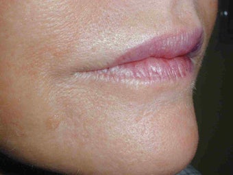 Juvederm and Botox to upper lip