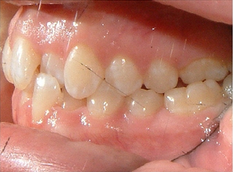Invisalign
