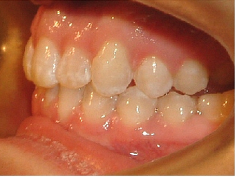 Invisalign