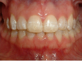 Invisalign