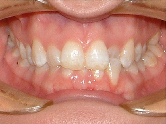 Invisalign