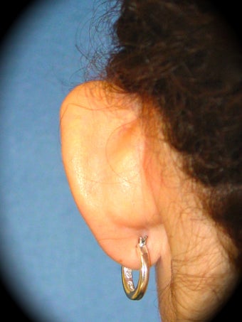 Otoplasty