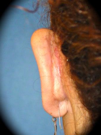 Otoplasty