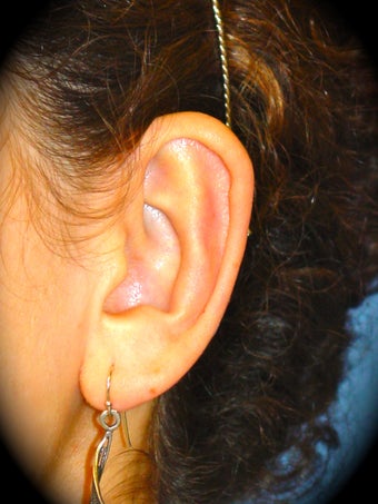 Otoplasty