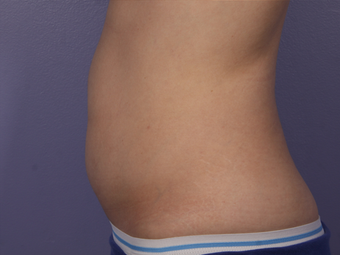 CoolSculpting to Abdomen