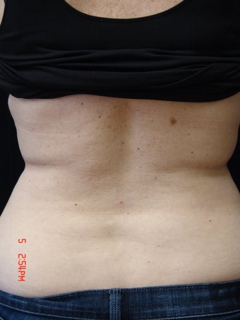 Coolsculpting
