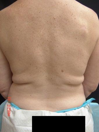 Coolsculpting