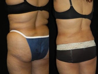 63 year old woman SmartLipo Waist and Flanks
