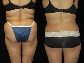 63 year old woman SmartLipo Waist and Flanks