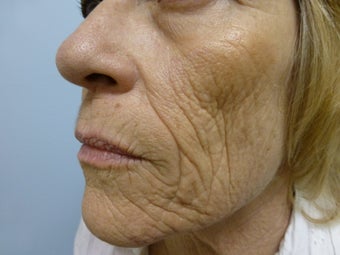 Ablative Laser Resurfacing