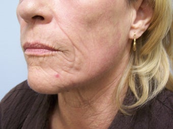 Ablative Laser Resurfacing