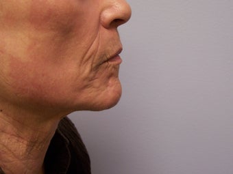 Ablative Laser Resurfacing