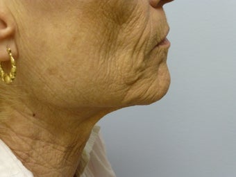 Ablative Laser Resurfacing