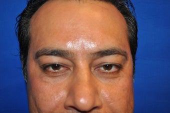 43 Year Old Male treated with Lower Eyelid Surgery to remove Puffy Eye Bags