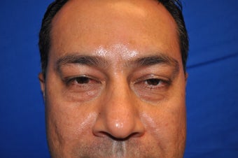 43 Year Old Male treated with Lower Eyelid Surgery to remove Puffy Eye Bags