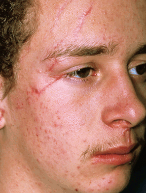 Scar Revision