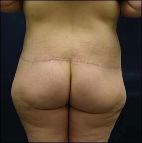 Butt Lift