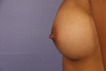 Inverted Nipple Repair