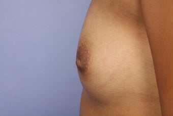 Inverted Nipple Repair
