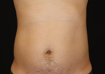 CoolSculpting by zeltiq