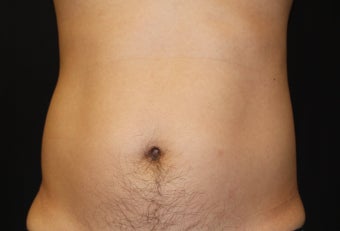 CoolSculpting by zeltiq