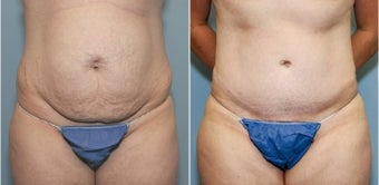 34 year old with excess abdominal skin