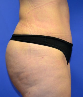 38 year old with lack of gluteal volume