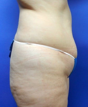 38 year old with lack of gluteal volume