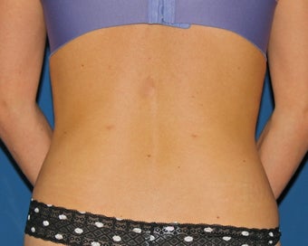 Vaser Liposuction of the Lower Back