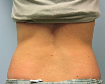 Vaser Liposuction of the Lower Back