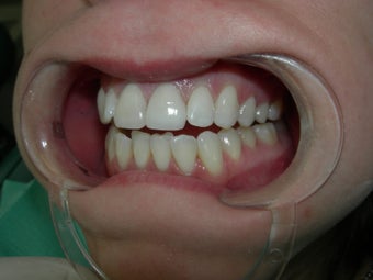 Porcelain Crowns
