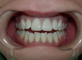 Porcelain Crowns