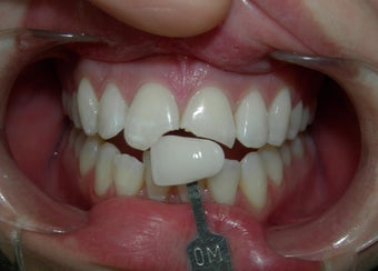 Porcelain Crowns