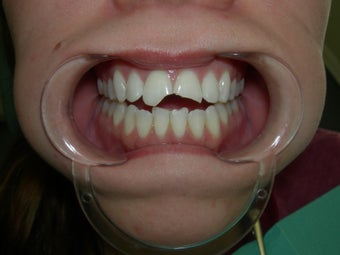 Porcelain Crowns