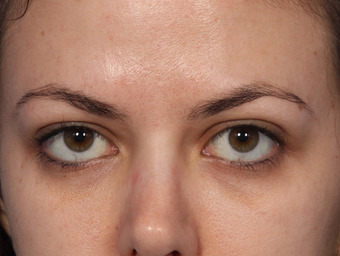 Botox Between Eyebrows