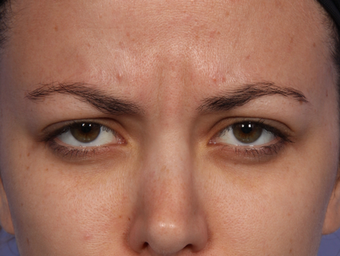 Botox Between Eyebrows