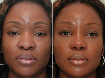 African American Rhinoplasty