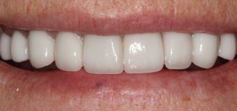 Porcelain Crowns and Porcelain Veneers