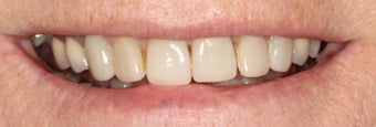 Porcelain Crowns and Porcelain Veneers