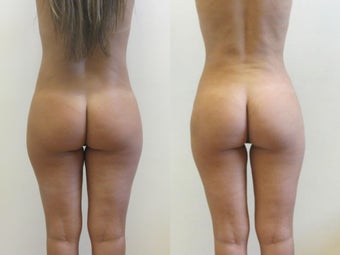 Brazilian butt lift