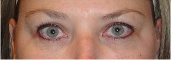 Restylane