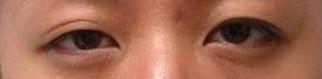 Bilateral Asian Eyelid Surgery