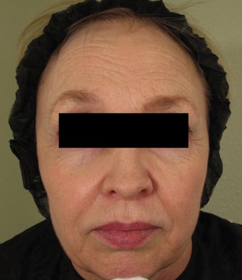 Facial rejuvenation with Sculptra, Dermapen, and Botox