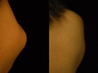 44 year-old Woman Treated for Lipoma on Right Upper Back