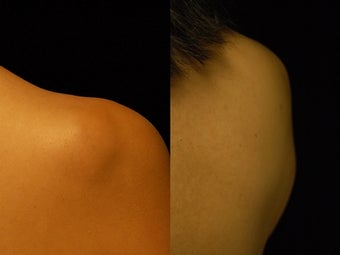 44 year-old Woman Treated for Lipoma on Right Upper Back