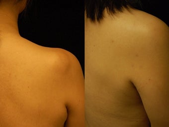 44 year-old Woman Treated for Lipoma on Right Upper Back