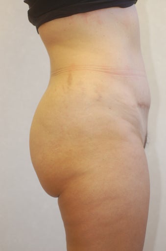 Buttock Enhancement